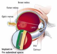 Las primeras prótesis de retina podrían llegar al mercado en 2011
