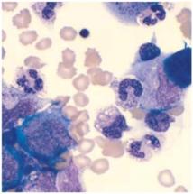 Las “células asesinas” contribuyen al desarrollo de la hepatitis