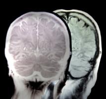Los hipertimésicos recuerdan al detalle cualquier día de su vida porque tienen un cerebro distinto