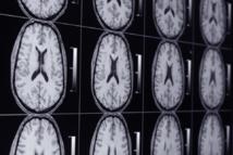 Estilos alternativos de pensamiento pueden paliar lesiones cerebrales