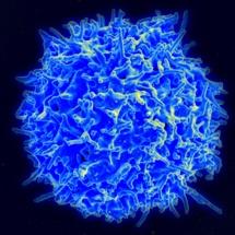 Una terapia celular consigue remisión completa de la leucemia en un 88% de casos