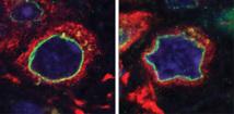 Los enfermos de Párkinson presentan deformaciones en sus células madre neurales