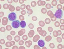 Descifran los primeros epigenomas de la leucemia linfática crónica
