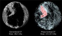 Nuevo método reduce en 25 veces la radiación necesaria para hacer mamografías