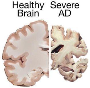 Encuentran las señales más precoces del Alzheimer