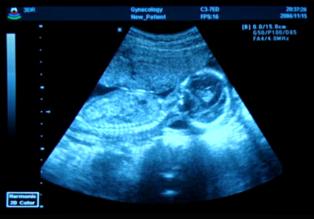 La sangre de la madre servirá para detectar enfermedades en fetos