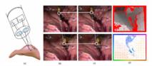 Un software con mapa virtual del cuerpo mejora la precisión de la cirugía robótica