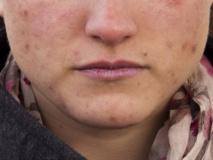 Nuevo tratamiento natural contra el acné mucho más efectivo que los artificiales