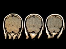 Extraña actividad neuronal en cerebros con “electroencefalograma plano”