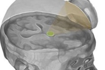 Reactivan el cerebro de un hombre en coma usando ultrasonidos