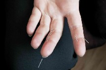 Tres investigaciones confirman la relativa eficacia de la acupuntura para algunas dolencias