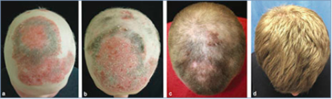 Un paciente con alopecia areata universal recupera todo su cabello 