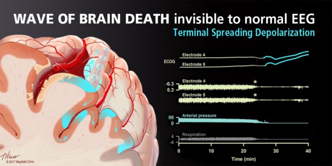 Descubren lo que pasa en el cerebro humano en el momento de la muerte