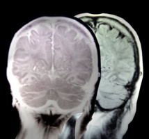 Niveles bajos de una proteína del cerebro aumentan el riesgo de neurodegeneración