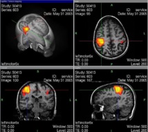 La psicoterapia normaliza la actividad del sistema límbico del cerebro