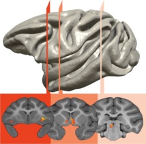 Un circuito cerebral hiperactivo está relacionado con la herencia de la ansiedad 