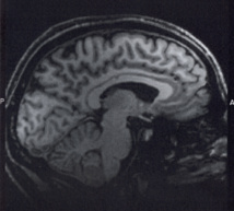 Escáneres cerebrales predicen la recuperación del coma a tres meses vista