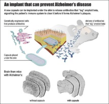 Nuevo implante para prevenir el Alzheimer