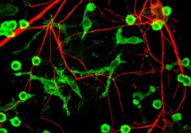 La acumulación de neuronas muertas en el cerebro agrava las enfermedades mentales