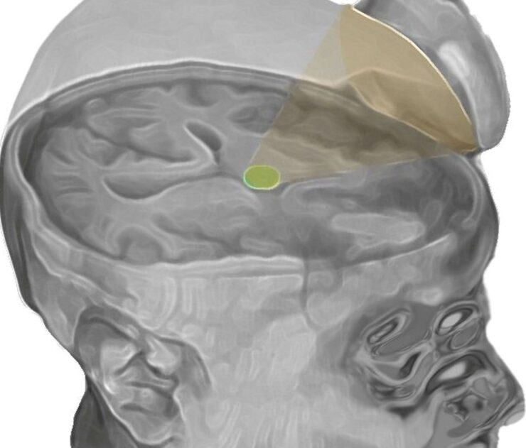 Recuperan con ultrasonido el cerebro de dos personas en coma